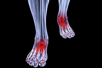 arthritic foot care