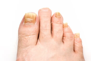 fungal toenails treatment in the Lumberton, NJ 08048 and Philadelphia, PA 19134 (Port Richmond) & 19144 (Germantown) area