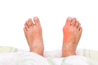 Common Reasons Why Bunions May Occur