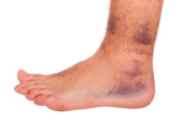 Who Is Prone to Foot and Ankle Injuries?