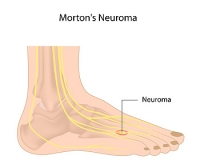 Morton’s Neuroma & the Toes